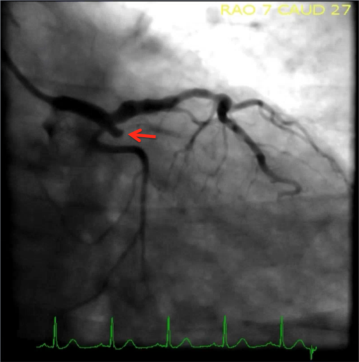 <p>One Hundred Percent&nbsp;proximal circumflex artery occlusion, TIMI flow 0</p>