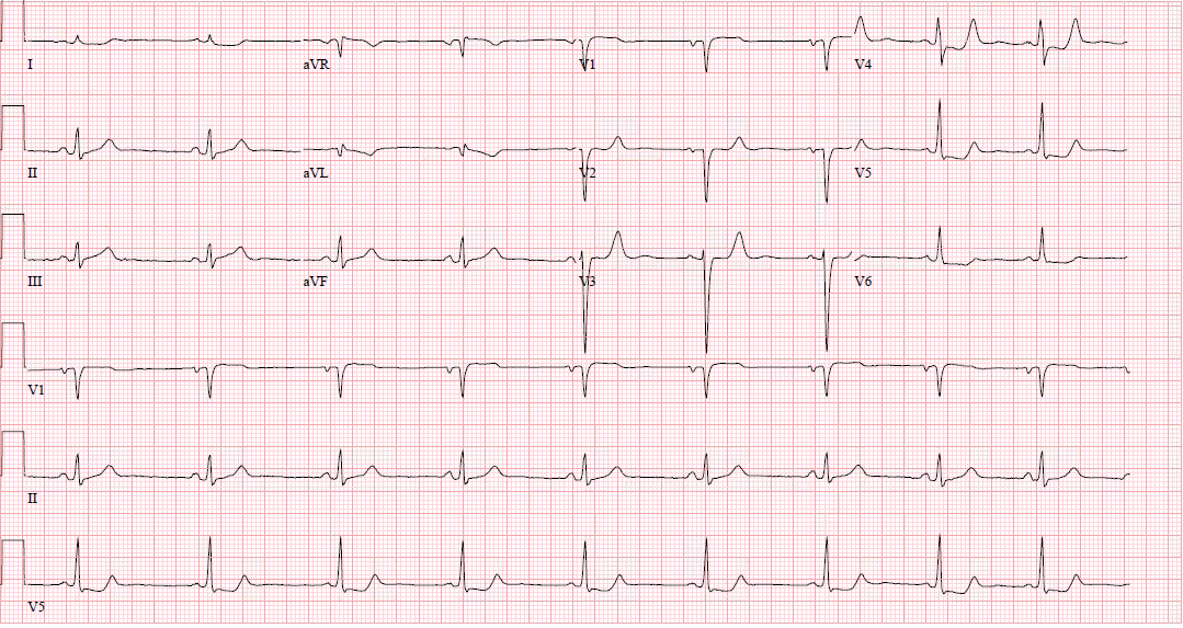 Isolated posterior myocardial infarction, cath proven 100% SVG -> PDA occlusion with TIMI flow 0