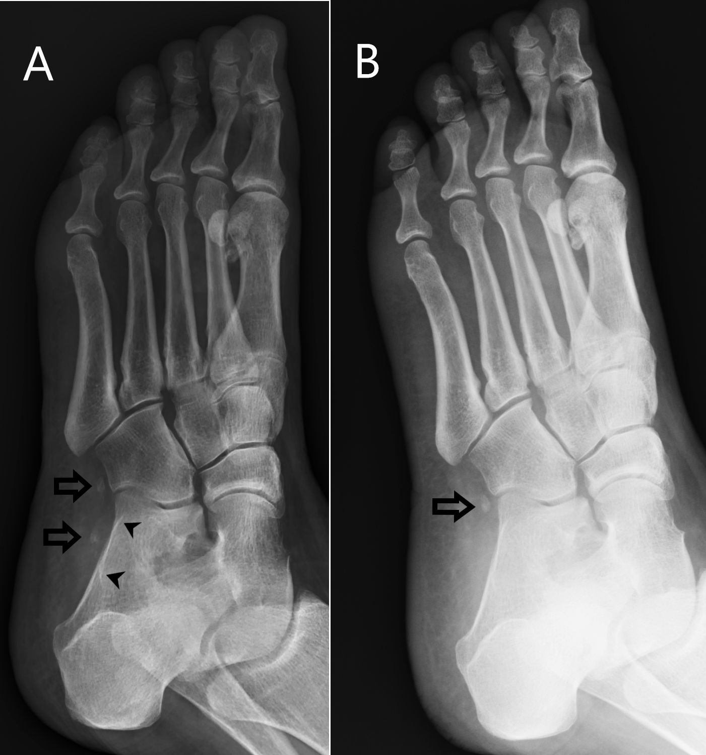 <p>Oblique Left Foot Radiograph Demonstrates a Fragmented Os Peroneus