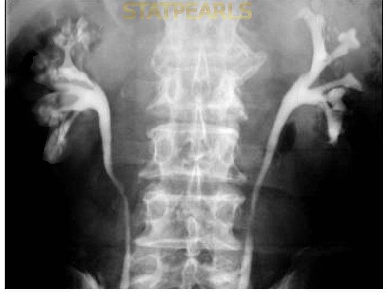 Medullary sponge kidney