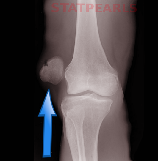 Patella dislocation