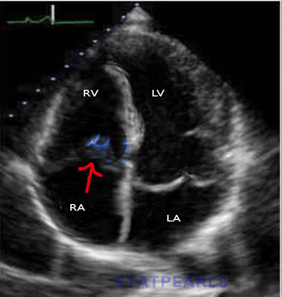 Tricuspid valve IE