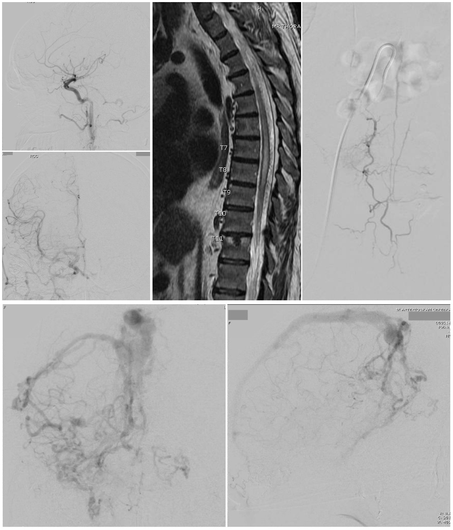 <p>Arteriovenous Fistula