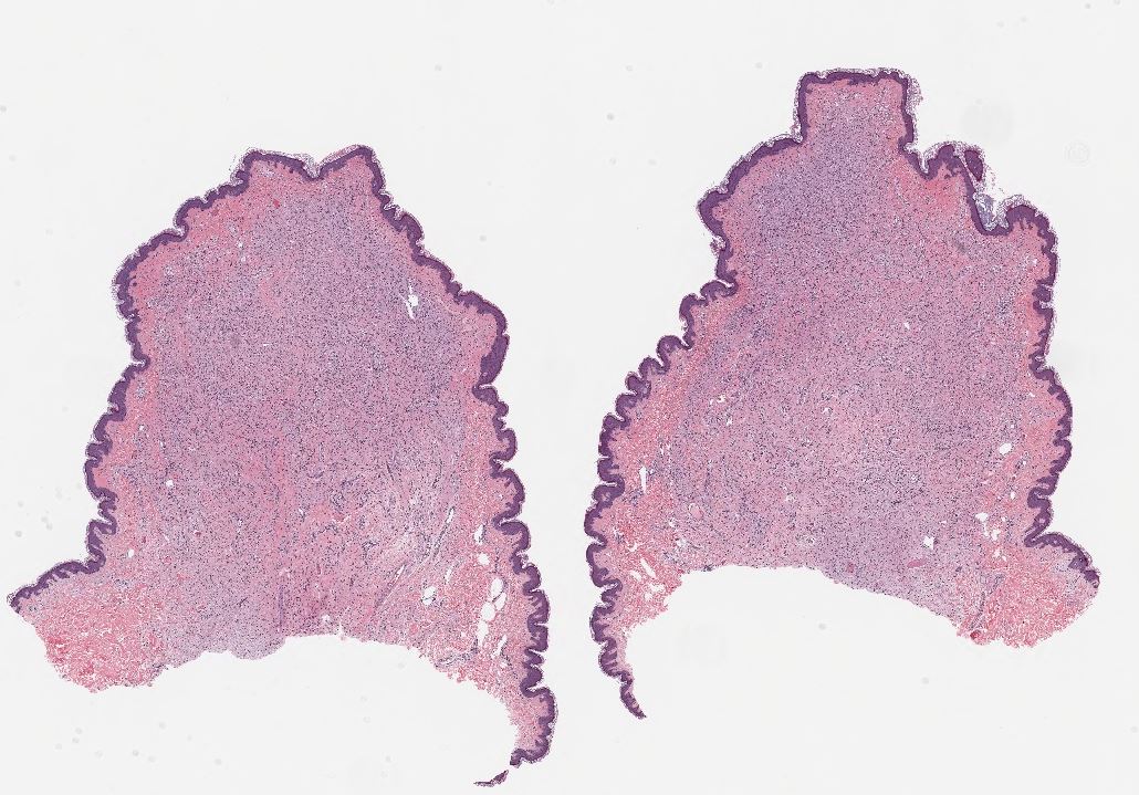 Neurofibroma, H&amp;E stain, 10x magnification.