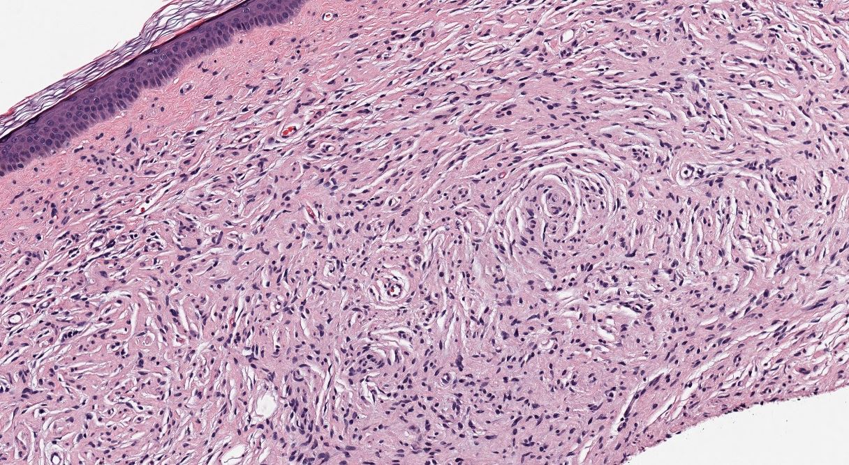 Neurofibroma, H&amp;E stain, 100X magnification.