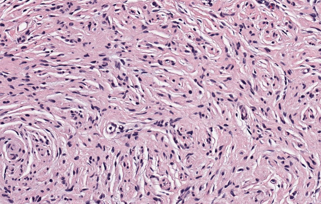 Neurofibroma, H&amp;E stain, 200X magnification.