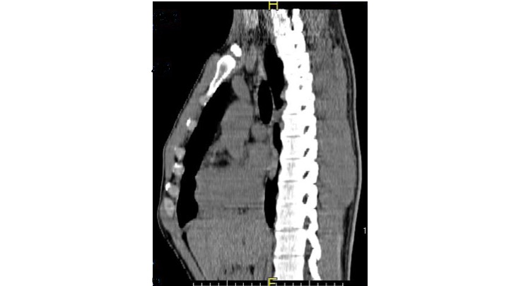 Chest CT scan, lateral view, pectus carinatum