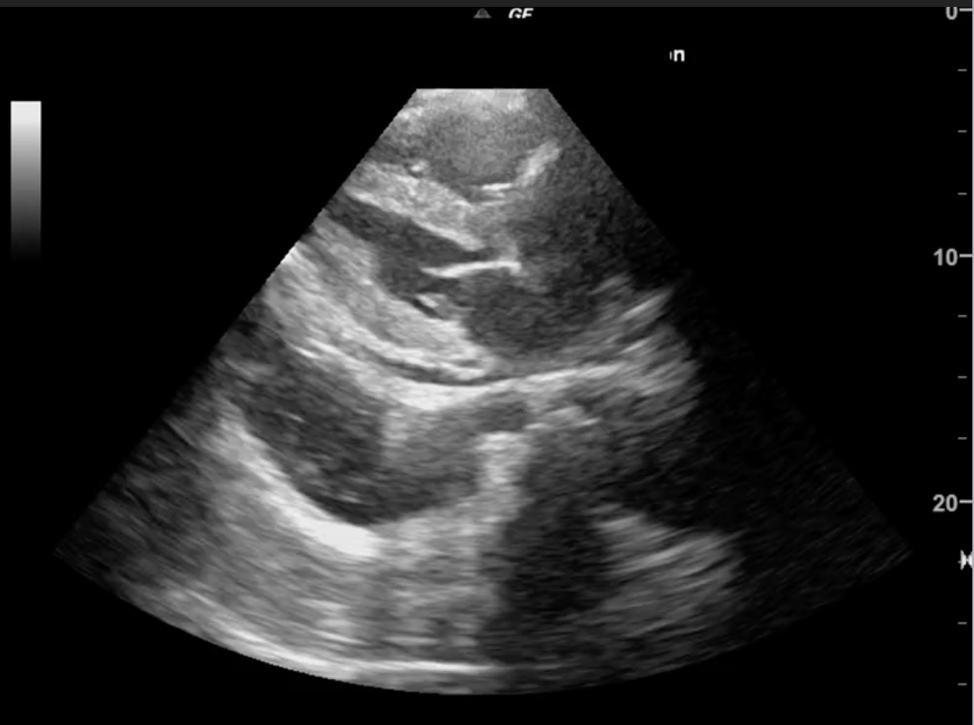 Hemothorax