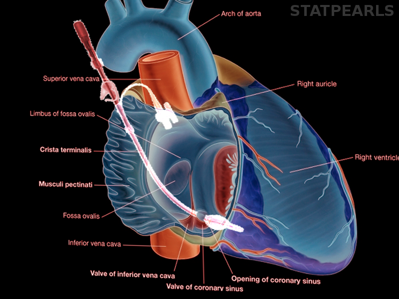 Retrograde cardioplegia