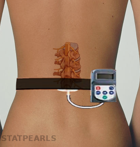 Peripheral nerve stimulator