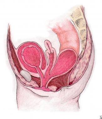 Cloacal malformation.