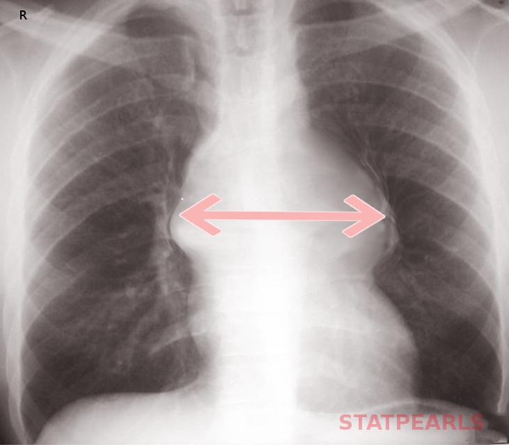 Wide Mediastinum