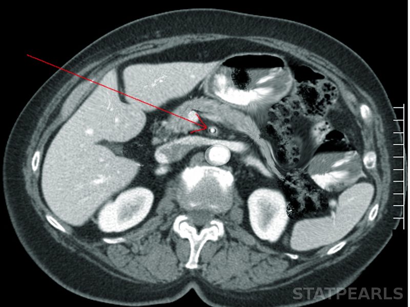 Superior mesenteric artery thrombosis