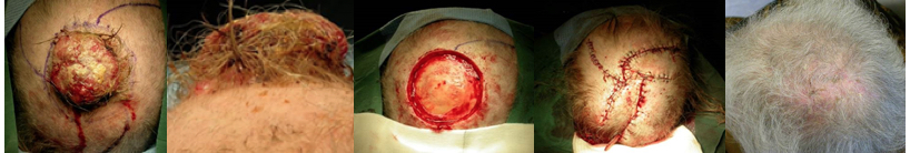 <p>Scalp Reconstruction