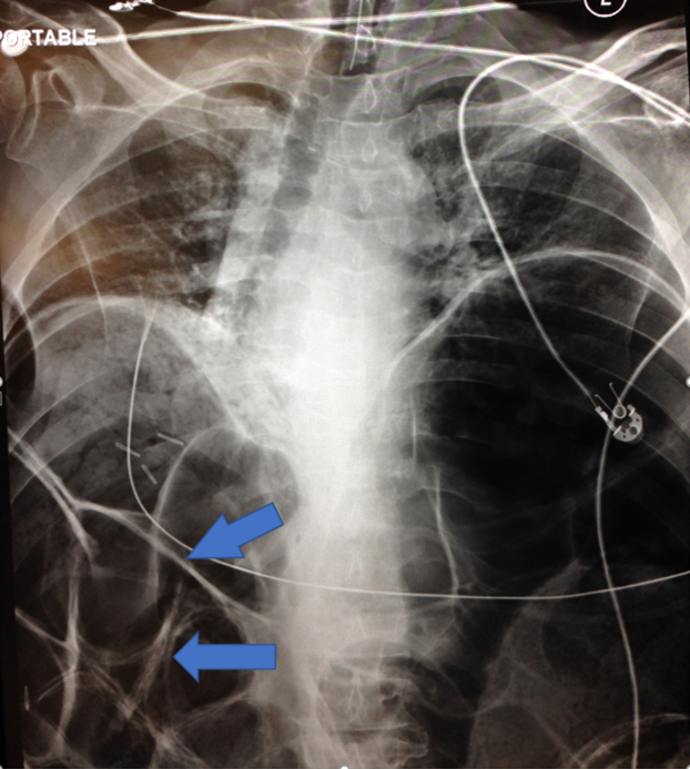 Rigler sign and massive free air on chest radiograph after intubation.