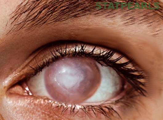 <p>Corneal Ulcer</p>