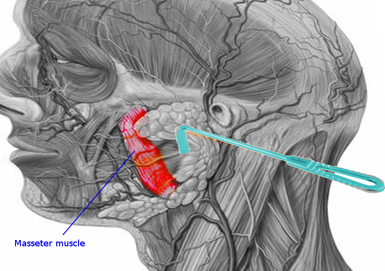 Masseter muscle