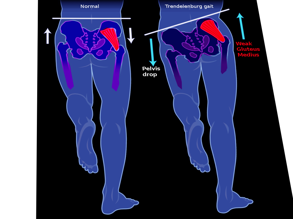 <p>Trendelenburg Gait. The left image shows a normal gait. The right image shows a Trendelenburg gait.</p>