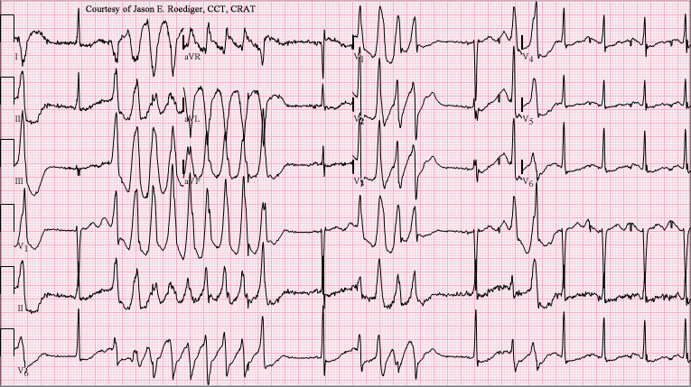 <p>ECG in a Patient With Torsades de Pointes