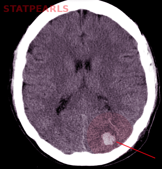 Cerebellar hemorrhage