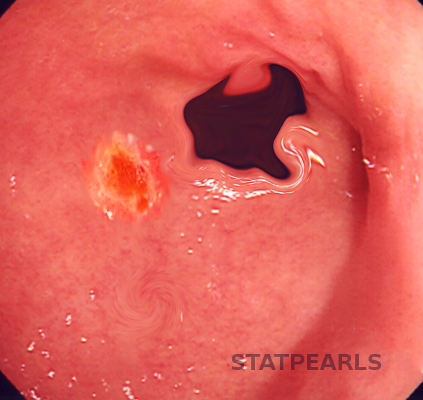 Duodenal ulcer