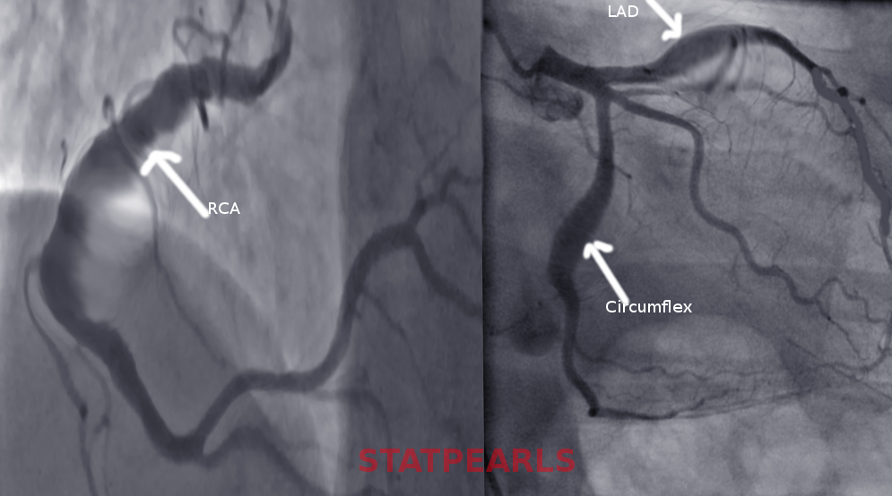 <p>Coronary Artery Ectasia. The image reveals CAE, a dilation of the coronary artery lumen.</p>