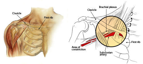 Thoracic Outlet Syndrome (TOS)