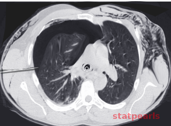 <p>Subcutaneous Emphysema</p>